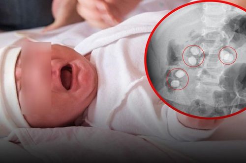 Bé 13 tháng tuổi quấy khóc đi khám phát hiện 6 viên sỏi trong bụng