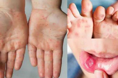 Đừng chủ quan với bệnh tay chân miệng: Thấy 6 biểu hiện này cần đi khám sớm