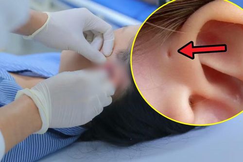 Lỗ nhỏ trước tai khiến cô gái 17 tuổi nhiều năm liên tục viêm nhiễm, áp xe