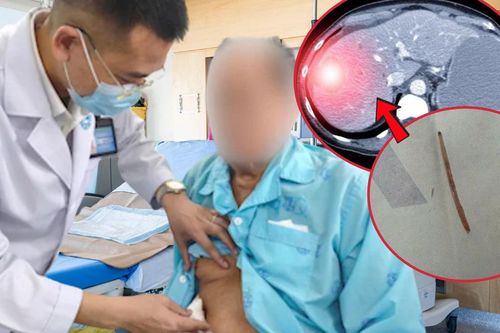 Người đàn ông sốc nhiễm trùng, bác sĩ phát hiện xương cá nằm trong gan