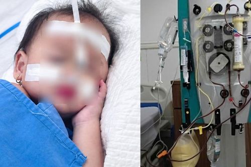 Từ cơn sốt thông thường, bé 2 tuổi hôn mê gan suýt chết