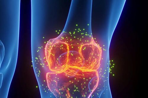 Cảnh báo loại thực phẩm gây nguy cơ tích mỡ vùng đùi và thoái hóa khớp