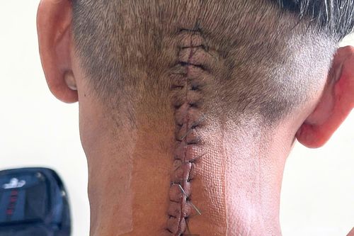 Ngủ võng sau khi nhậu say, người đàn ông đi cấp cứu vì gãy cổ