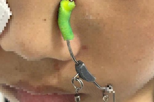 Đi học về, bé trai 11 tuổi ở Hà Nội bị lưỡi câu găm sâu vào mặt