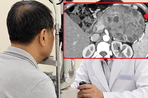 Đi khám vì mắt mờ, phát hiện khối u 5cm ở tụy