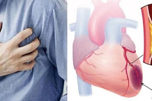 Nhồi máu cơ tim cấp do tắc mạch vành ở người hút thuốc lá nhiều năm