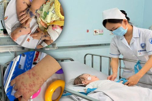 Gần 1/3 ca tay chân miệng nhập viện là ca nặng, bệnh viện dự phòng hơn 100 giường