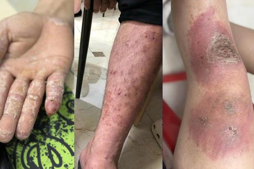 Lội nước ngập nhiều giờ, bàn chân có 5 dấu hiệu này cần đi khám ngay