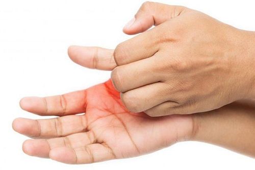 Ngứa lòng bàn tay, bàn chân kéo dài: Cẩn thận dấu hiệu liên quan đến bệnh gan