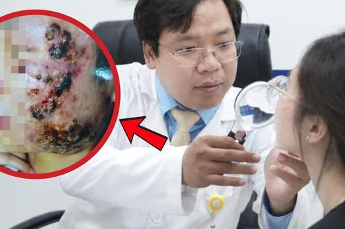Tin lời sạch mụn sau 3 ngày, nữ sinh 20 tuổi mặt sưng nề 'như ong đốt'