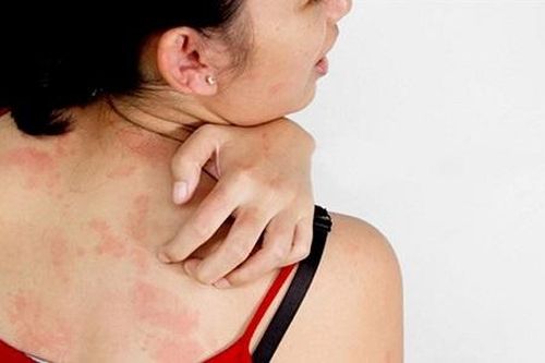 Khối lạ dưới da 'biết di chuyển', cảnh báo không nên bỏ qua
