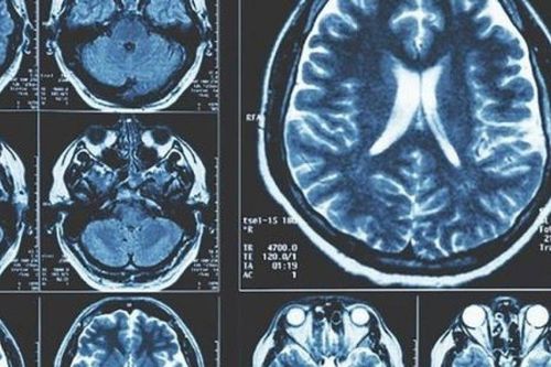 Mở hướng tiếp cận mới trong nghiên cứu điều trị Parkinson