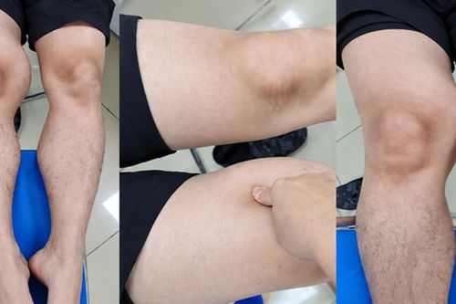 Đùi phình to như quả bóng suốt 1 năm, đi khám phát hiện ung thư hiếm gặp