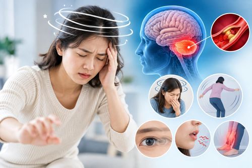 Chóng mặt, buồn nôn, mất thăng bằng: Khi nào là dấu hiệu đột quỵ?