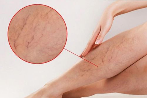 Tưởng mỏi chân do đứng bán hàng, đi khám phát hiện tĩnh mạch hiển suy nặng