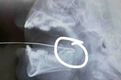 Bất cẩn khi đùa giỡn, bé 13 tháng tuổi bị ăng ten đồ chơi xuyên qua lưỡi