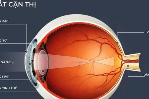 5 thói quen khiến độ cận ngày càng tăng nhanh