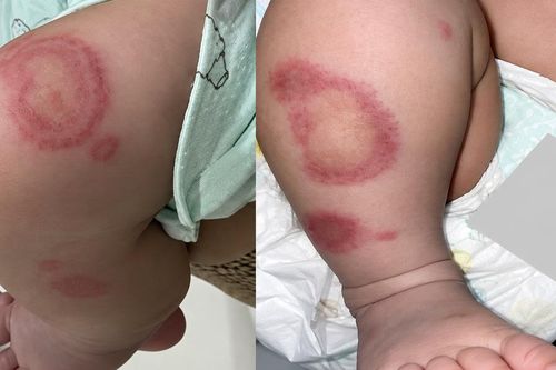 Em bé 26 ngày tuổi mắc lupus sơ sinh, khắp người xuất hiện mảng đỏ bất thường