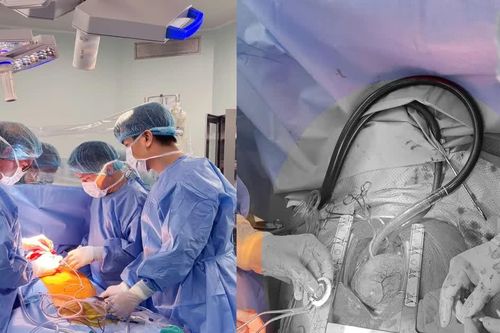 Ca cấy ghép thiết bị hỗ trợ tim CorHeart 6 đầu tiên tại Việt Nam