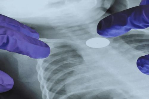 Một đột biến gene khiến nguy cơ ung thư phổi tăng 60 lần