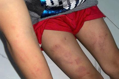 Công an điều tra vụ bé trai bị bầm tím sau khi gửi tại điểm trông trẻ ở Khánh Hòa