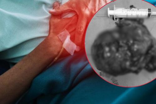 Sụt cân bất thường, người đàn ông 43 tuổi phát hiện khối u thận nặng 2kg