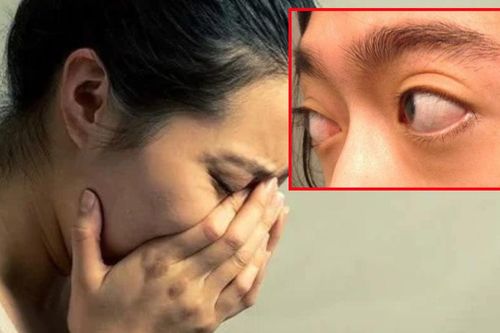 Mắt lồi bất thường, người phụ nữ phát hiện khối u nằm sâu sau nhãn cầu