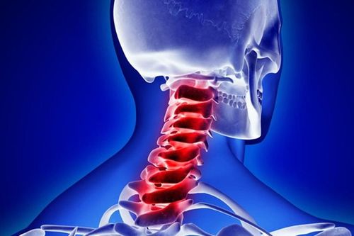 Ai cần thận trọng hoặc không nên tự ý kéo giãn cột sống cổ?