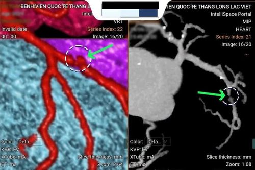 Đau ngực 2 giờ, người đàn ông 52 tuổi phát hiện hẹp nặng mạch vành