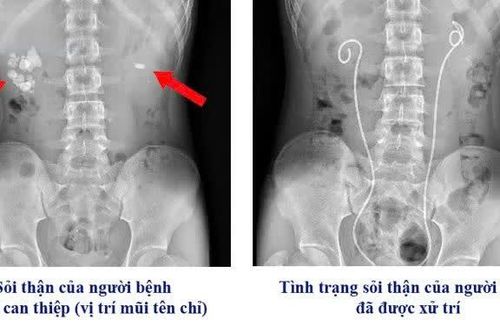 Đau thắt lưng, thiếu niên 16 tuổi suy thận cấp vì sỏi thận, niệu quản