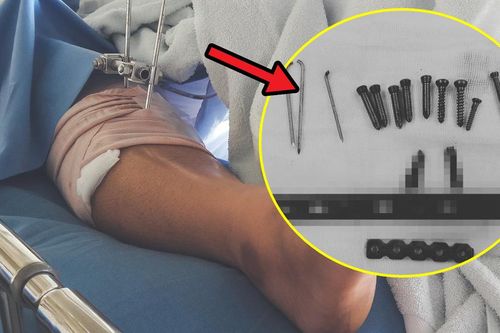 'Quên' nẹp vít gần 4 năm trong chân, bệnh nhân bất ngờ gặp sự cố khi tháo