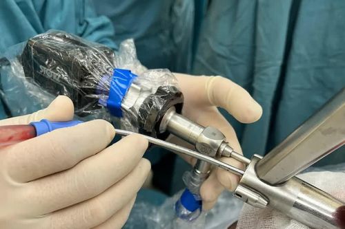 Biến chứng liệt 2 dây thanh âm, nữ bệnh nhân 60 tuổi nguy kịch