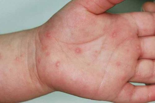 Tp.HCM ghi nhận số ca tay chân miệng tăng 47% trong một tuần