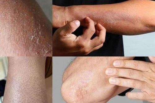 Ngứa kéo dài ở đâu và đi kèm dấu hiệu gì thì nên đi khám?