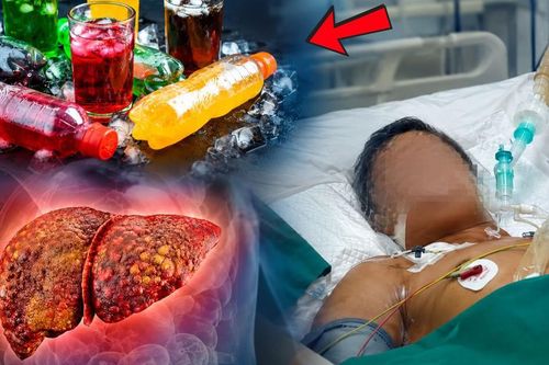 Uống nhiều nước ngọt có làm tăng nguy cơ ung thư gan?