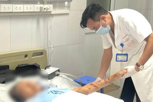 Hai người bị chó cắn với nhiều vết thương nghiêm trọng