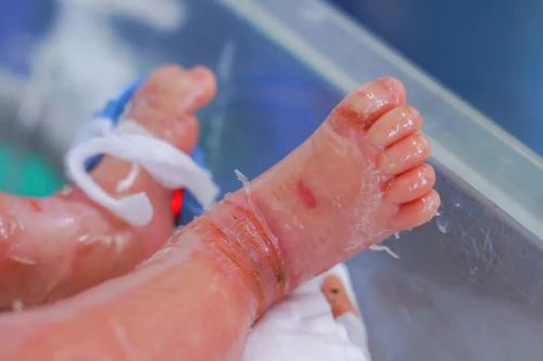 Bé sơ sinh mắc bệnh hiếm gặp, da bong như vảy cá
