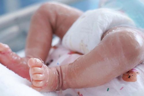 Bé trai sơ sinh da như vảy cá, mi mắt lộn ngược
