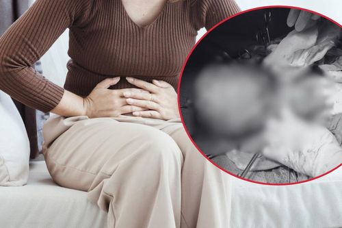 Hay thấy nặng bụng, đi khám phát hiện khối u xơ tử cung 17cm