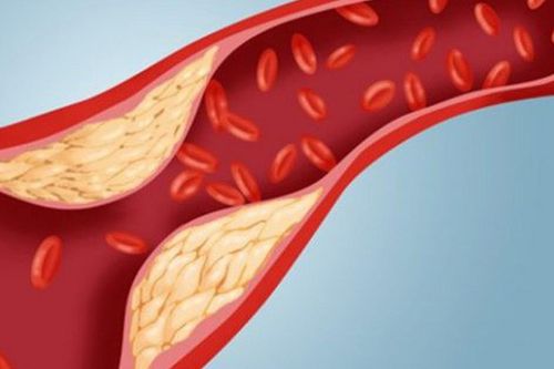 3 hiểu lầm phổ biến về mỡ máu
