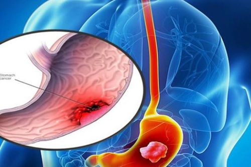 6 dấu hiệu cảnh báo ung thư dạ dày cần biết