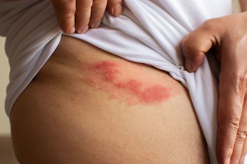 Căn bệnh dễ lây qua tiếp xúc, bắt tay cũng có thể là tác nhân