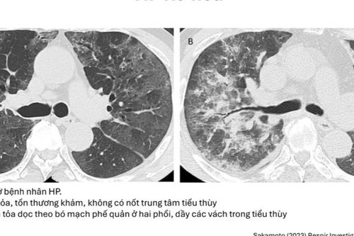 Ho khan, khó thở kéo dài: Cảnh giác với bệnh phổi kẽ