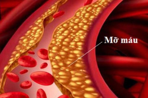 Làm thế nào để biết mình đang bị máu nhiễm mỡ?