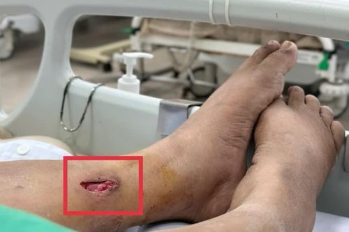 Vết thương đã lành, mảnh tre 3 cm vẫn nằm trong chân gây uốn ván