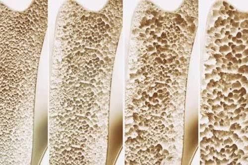 Mối liên hệ giữa mật độ xương thấp và nguy cơ suy giảm nhận thức