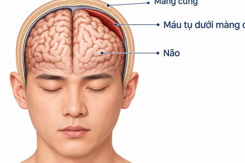 Đau đầu kéo dài 7 ngày, nam bệnh nhân 32 tuổi phát hiện tụ máu dưới màng cứng dày 19 mm