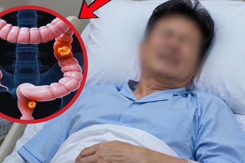 Đau mông kéo dài, người đàn ông 54 tuổi giật mình phát hiện ung thư
