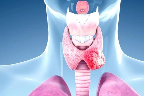 Điều trị ung thư tuyến giáp cần cá thể hóa