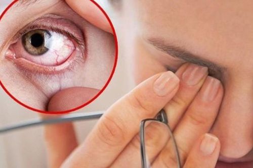 Chăm sóc người bị xuất huyết dưới kết mạc tại nhà